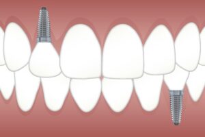 Innovative Marketing Strategies for Dental Implant Specialists