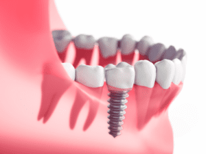 Implant Impact Marketing: Transforming Smiles, Elevating Practice